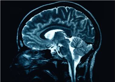 Inteligența artificială revoluționează diagnosticarea bolii Alzheimer, atingând o precizie aproape de 93% în detectarea precoce a acestei afecțiuni neurodegenerative