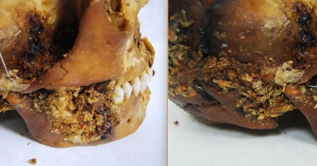 O descoperire remarcabilă din lumea arheologiei a adus în prim-plan un caz unic, ce pune în lumină abilitățile avansate ale medicinii în civilizațiile antice