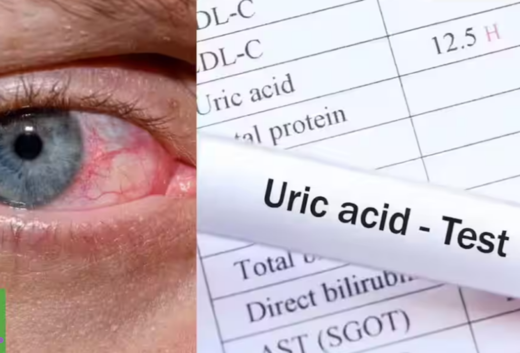 Acidul uric crescut devine tot mai frecvent întâlnit în rândul românilor, fiind adesea considerat un semnal de alarmă pentru sănătatea rinichilor și a articulațiilor