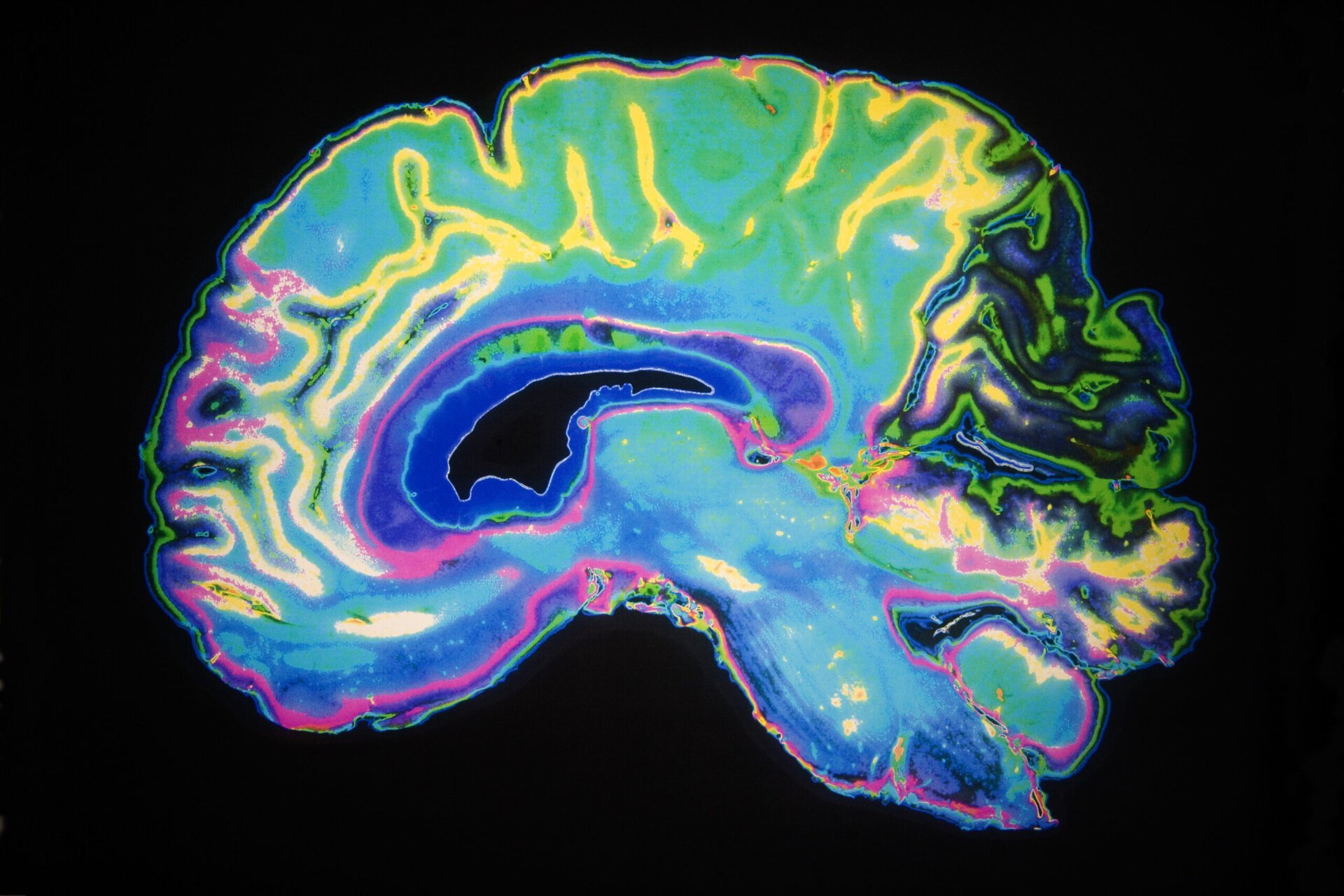 Cercetători de la UCLA Health și UC San Francisco au făcut o descoperire promițătoare în lupta împotriva bolii Alzheimer, explicând de ce unii neuroni rezistă mai bine la acumularea de proteina tau, o componentă toxică strâns legată de această maladie neurodegenerativă