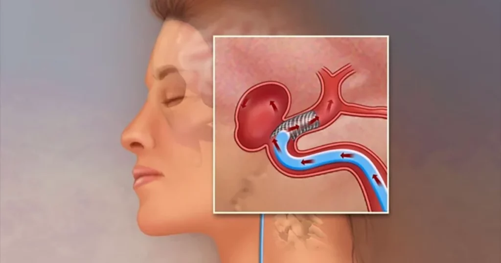 Un avertisment serios pentru sănătate: atenție la cele două simptome care pot indica un anevrism cerebral Un medic neurolog atrage atenția asupra unui pericol ascuns, uneori fatal, care poate afecta oricine: anevrismul cerebral