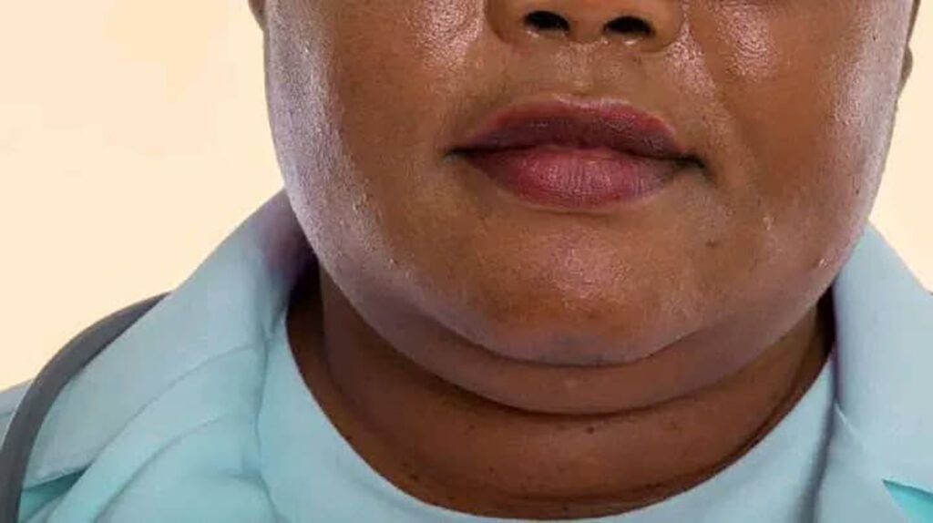Bărbia dublă, de multe ori percepută doar ca o problemă estetică, capătă acum un nou sens în rândul specialiștilor în sănătate