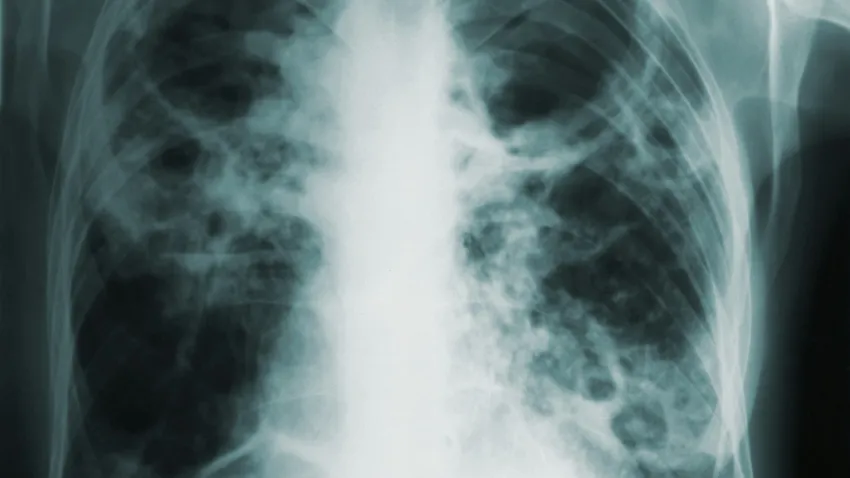 Bucureștiul marchează Ziua Mondială de Luptă Împotriva Tuberculozei printr-un gest simbolic și acțiuni de conștientizare În cadrul eforturilor globale de a combate tuberculoza, o boală extrem de contagioasă și dificil de eradicat, orașul București face un pas simbolic dar puternic de solidaritate