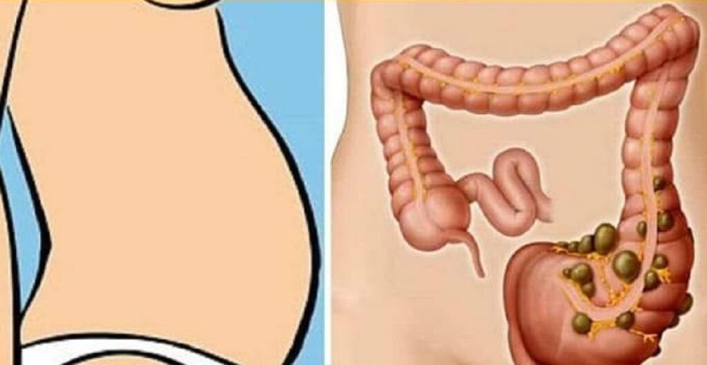 Constipația, o problemă digestivă frecvent întâlnită, afectează milioane de oameni de toate vârstele și reprezintă un motiv comun pentru consultul medical