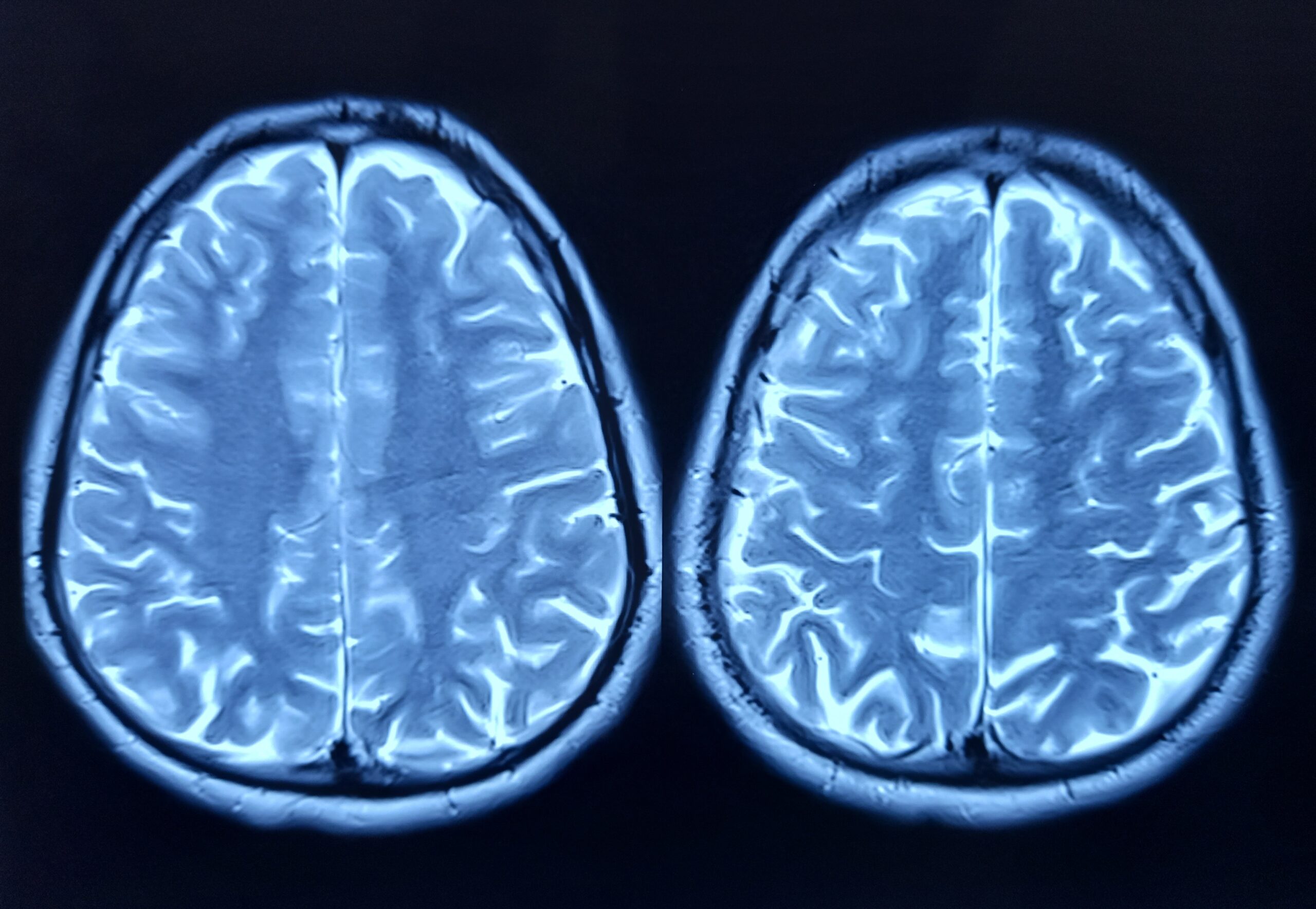 Celule cerebrale umane conectate la cipuri de siliciu au jucat Doom, o realizare revoluționară în domeniul calcului biologic Un pas important în evoluția tehnologiei și științei a fost făcut de cercetătorii australieni, care au reușit să doteze celulele cerebrale umane vii cu capabilitatea de a controla un joc video complex precum Doom, folosind un sistem hibrid de hardware și biologie