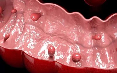 Riscul de cancer al polipilor sesili din colon: ce trebuie să știi