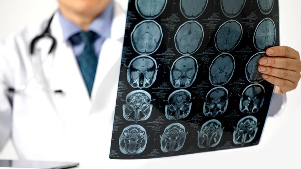 Monitorizarea colesterolului, un pas în sine insuficient în prevenția accidentului vascular cerebral Riscul de accident vascular cerebral (AVC) rămâne una dintre principalele cauze de mortalitate și dizabilitate în România, iar prevenția continuă să fie o prioritate pentru medicii specialiști