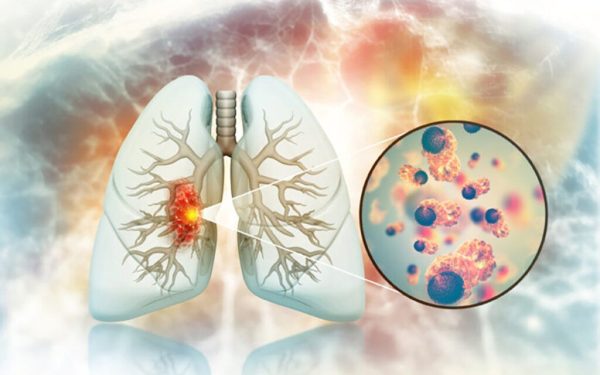 Cancer de plămâni la nefumători: Legătură ȘOCANTĂ cu fructe și legume