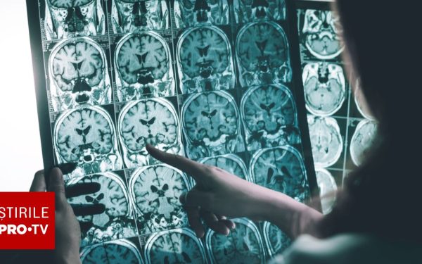 Medicamente pentru Alzheimer: Analiză cruntă, riscuri mai mari decât beneficii