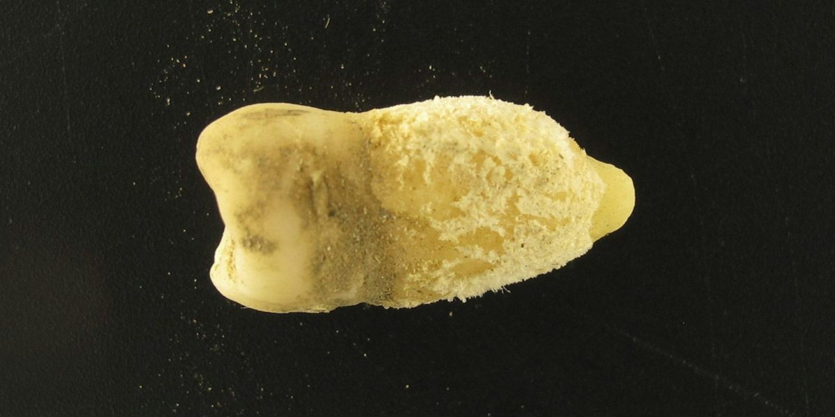 Bacterie de scarlatină, găsită într-o mumie! Descoperirea uluitoare schimbă istoria