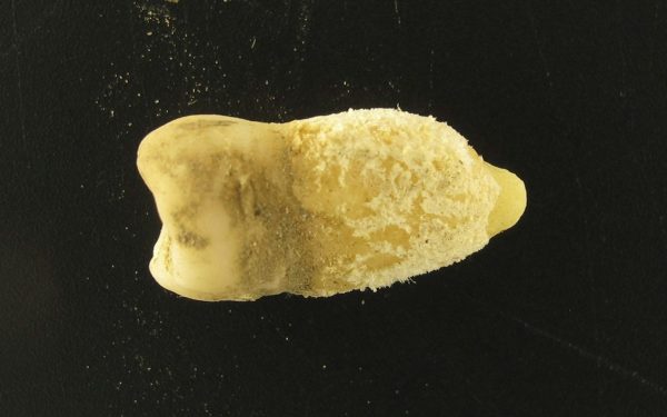 Bacterie de scarlatină, găsită într-o mumie! Descoperirea uluitoare schimbă istoria