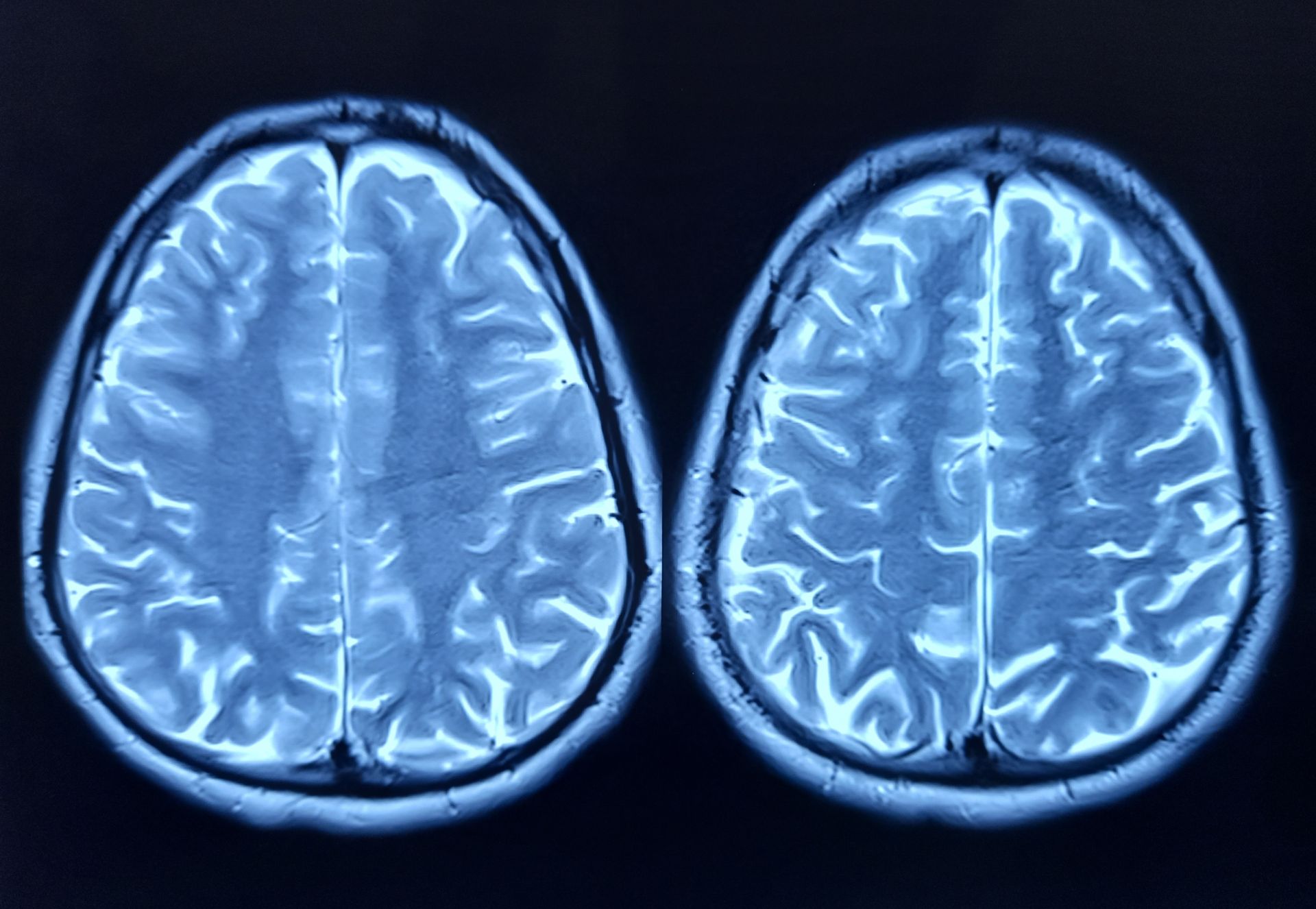 O descoperire revoluționară despre îmbătrânirea creierului: proteina FTL1 Cercetătorii au identificat o proteină numită FTL1, responsabilă pentru declinul cognitiv asociat cu îmbătrânirea creierului