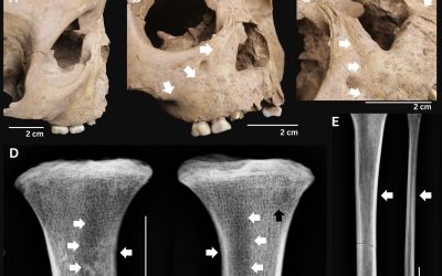 Dinții copilor antici relevă o boală gravă de acum 4.000 de ani