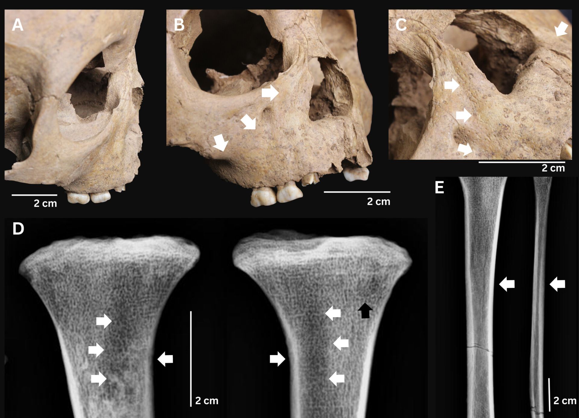 Arheologii din Vietnam au descoperit câțiva copii din Epoca de Piatră care sufereau de o boală bacterială gravă, similara sifilisului, iar această descoperire poate schimba modul în care istoricii înțeleg originile acestei maladii