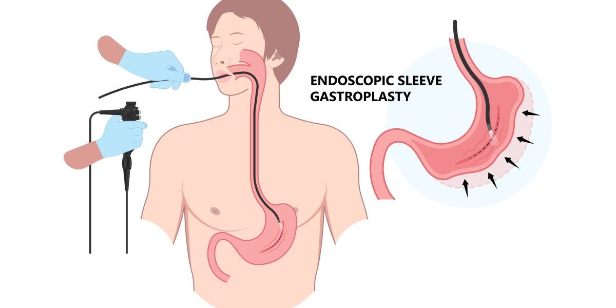 EȘECUL slăbirii? O nouă metodă endoscopică, fără bisturiu