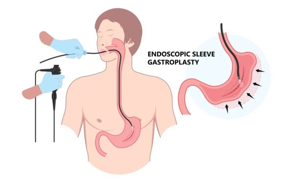 EȘECUL slăbirii? O nouă metodă endoscopică, fără bisturiu