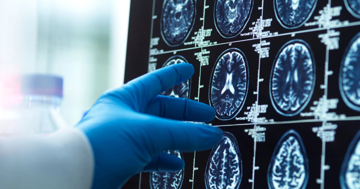 Prima hartă detaliată a îmbătrânirii creierului: de ce unele zone sunt mai vulnerabile la Alzheimer O nouă cercetare dezvăluie cele mai detaliate hărți ale creierului uman în procesul de îmbătrânire, evidențiind zonele care sunt cele mai susceptibile la dezvoltarea bolii Alzheimer