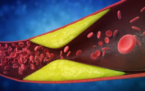 7 semne subtile ale arterelor blocate: Cardiologii trag un semnal de alarmă