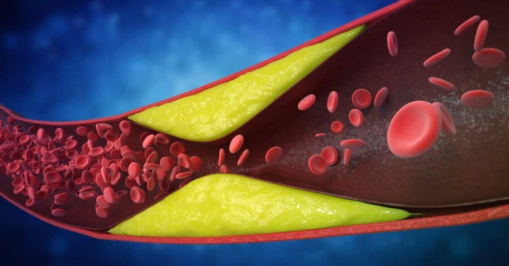 7 semne subtile ale arterelor blocate: Cardiologii trag un semnal de alarmă