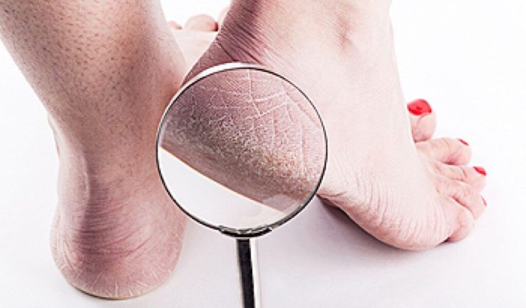 Culoarea călcâielor, semn de boală de ficat. Avertisment de la medic