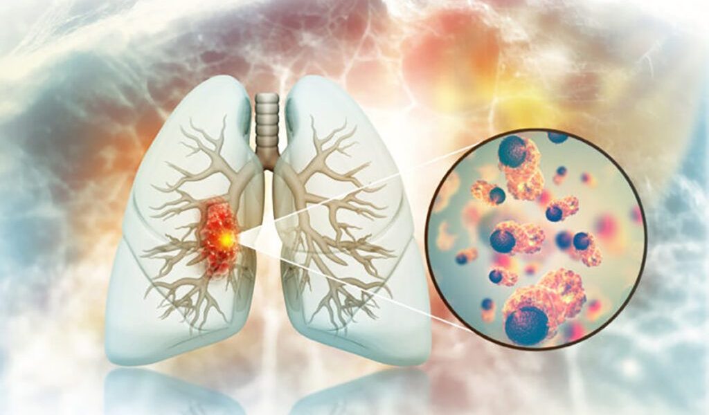 Creștere alarmantă a cancerului pulmonar la nefumători: Medici, uluiți de cauze