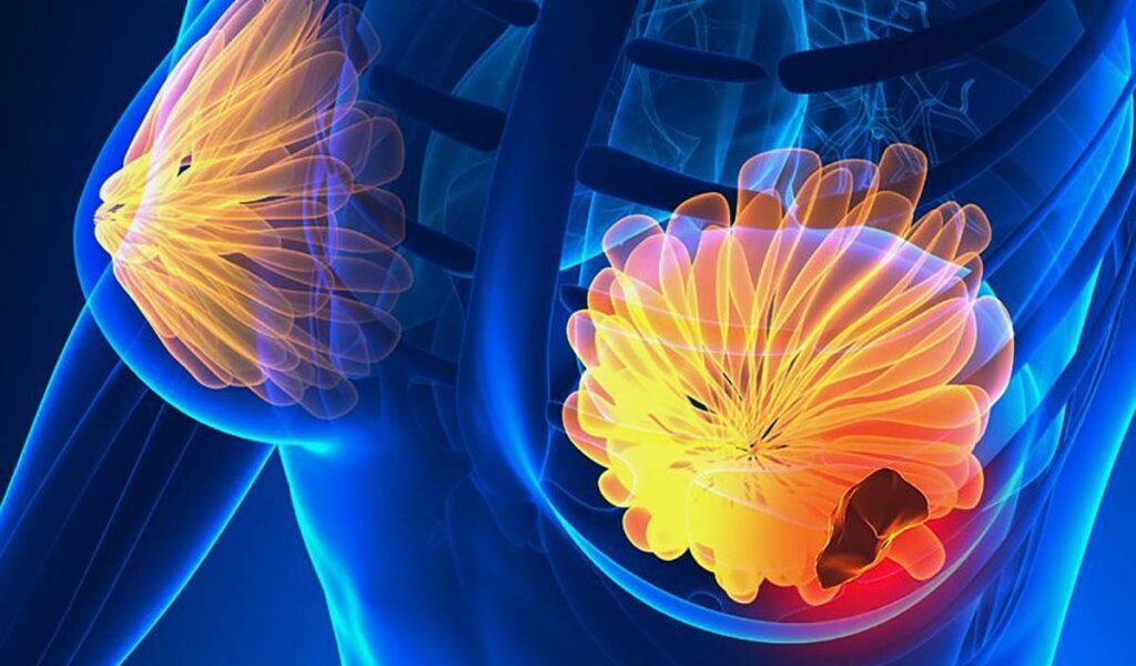 Semnele cancerului de sân: 5 simptome la care trebuie să fii atentă!