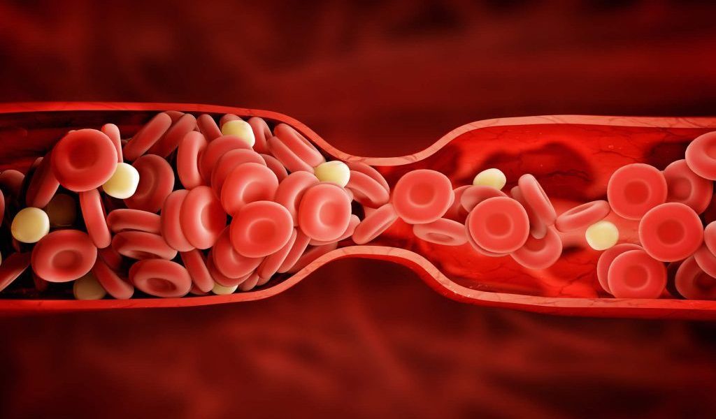 Semnale alarmante: Cheag de sânge, o amenințare ascunsă