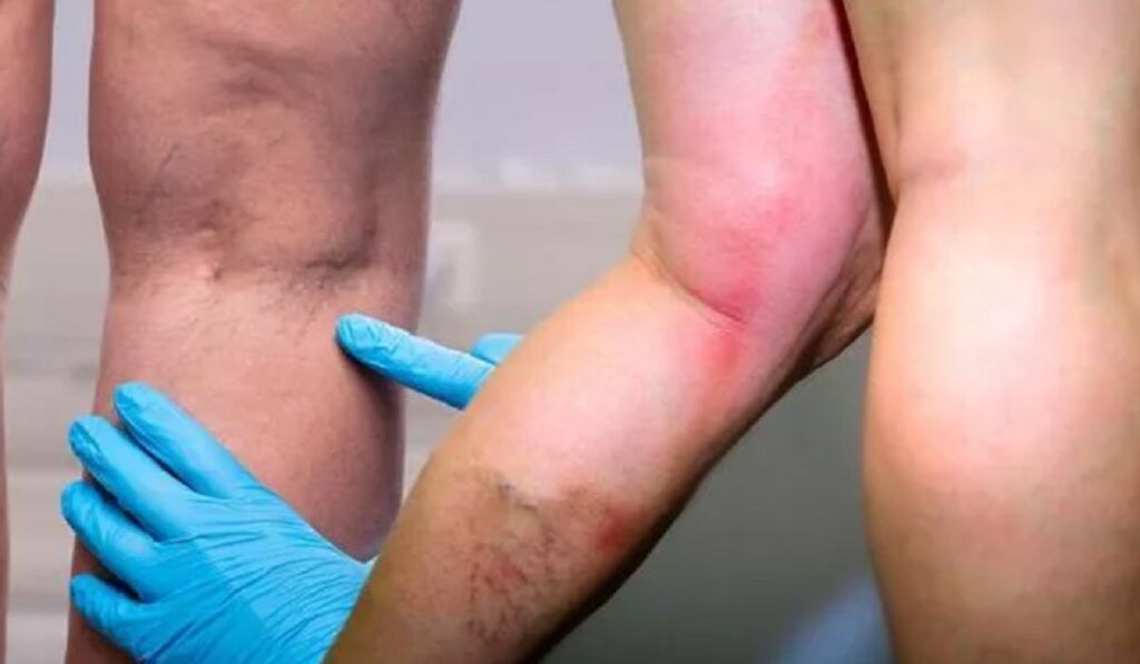 Vitamina-minune: Protejează de cheaguri și întărește imunitatea