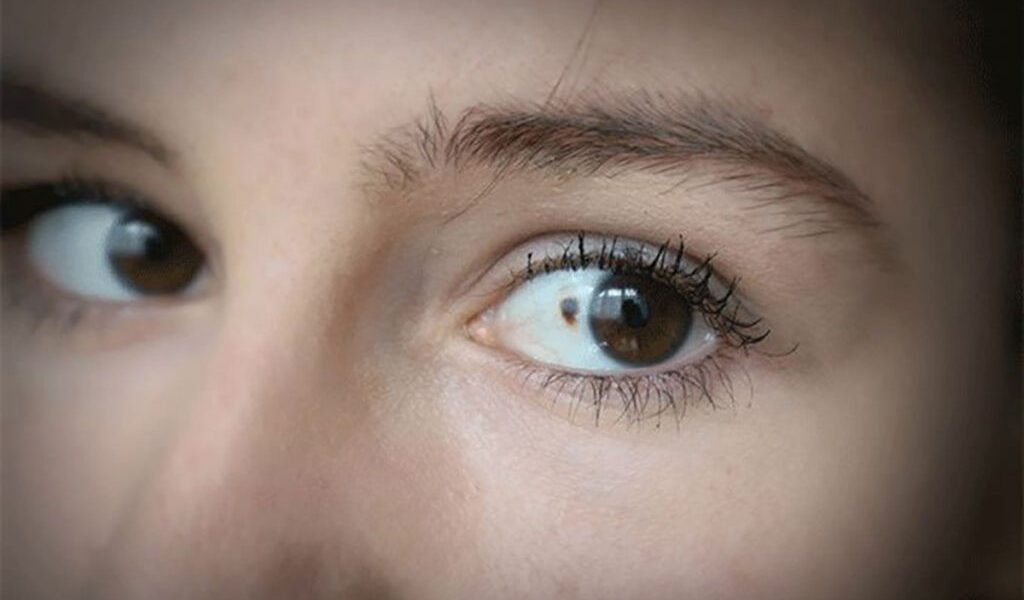 Uită-te-n Ochi: 11 semne TĂCUTE de cancer, depistabile din privirea ta!
