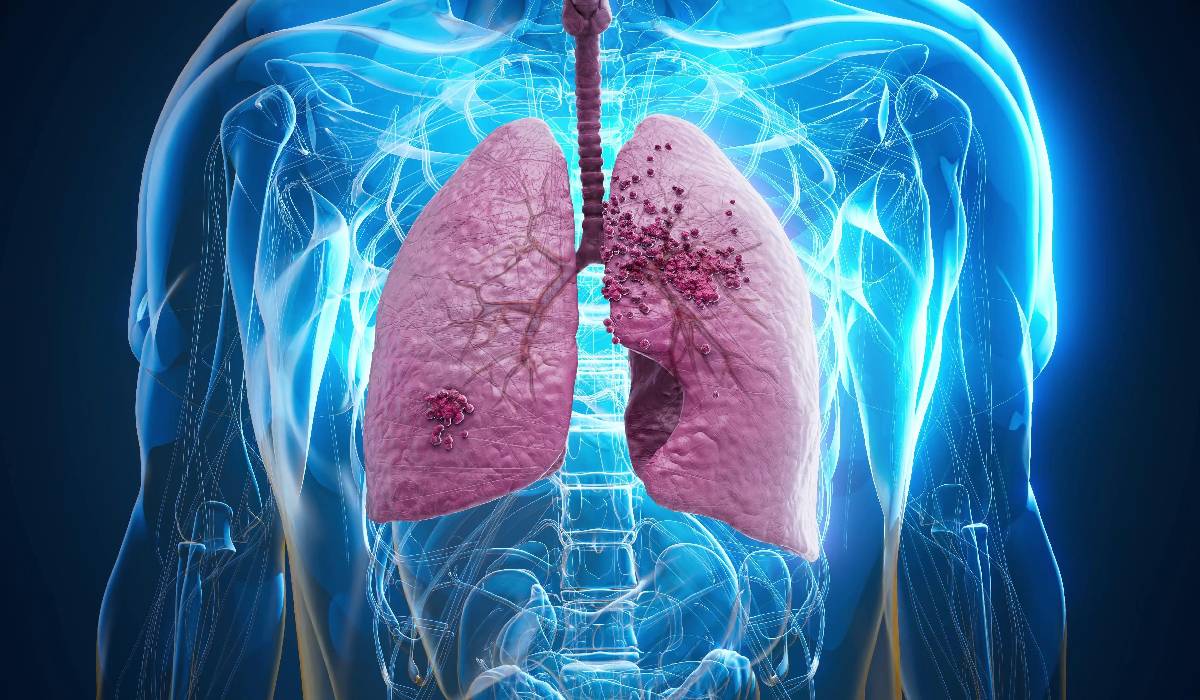 Munca de AUR: Miturile despre cancerul pulmonar demontate
