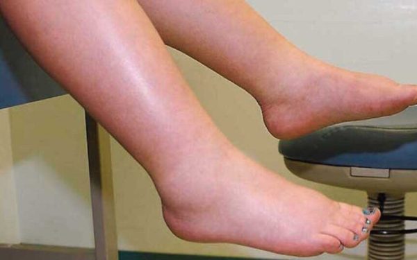 Leguma minune: Spune „adio” picioarelor umflate și circulației proaste