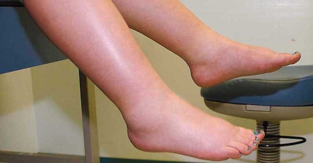 Leguma minune: Spune „adio” picioarelor umflate și circulației proaste