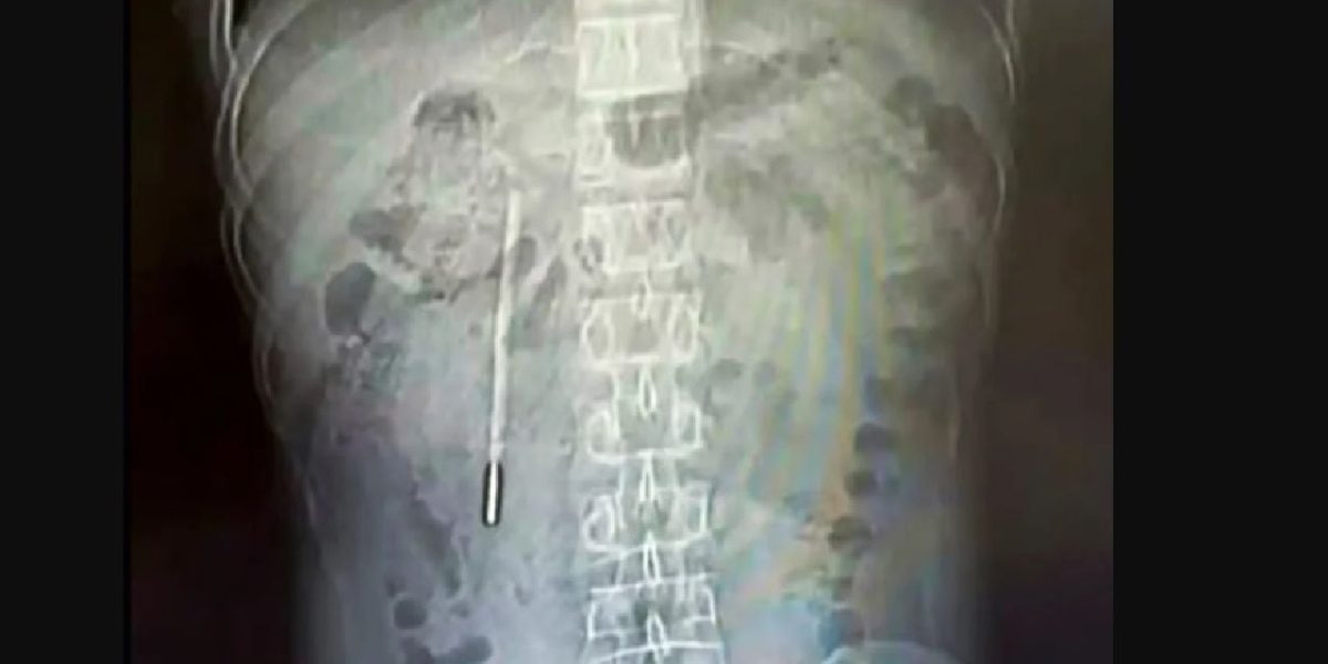 Medici, ȘOCAȚI: Ce au găsit în stomacul unui chinez după 20 de ani