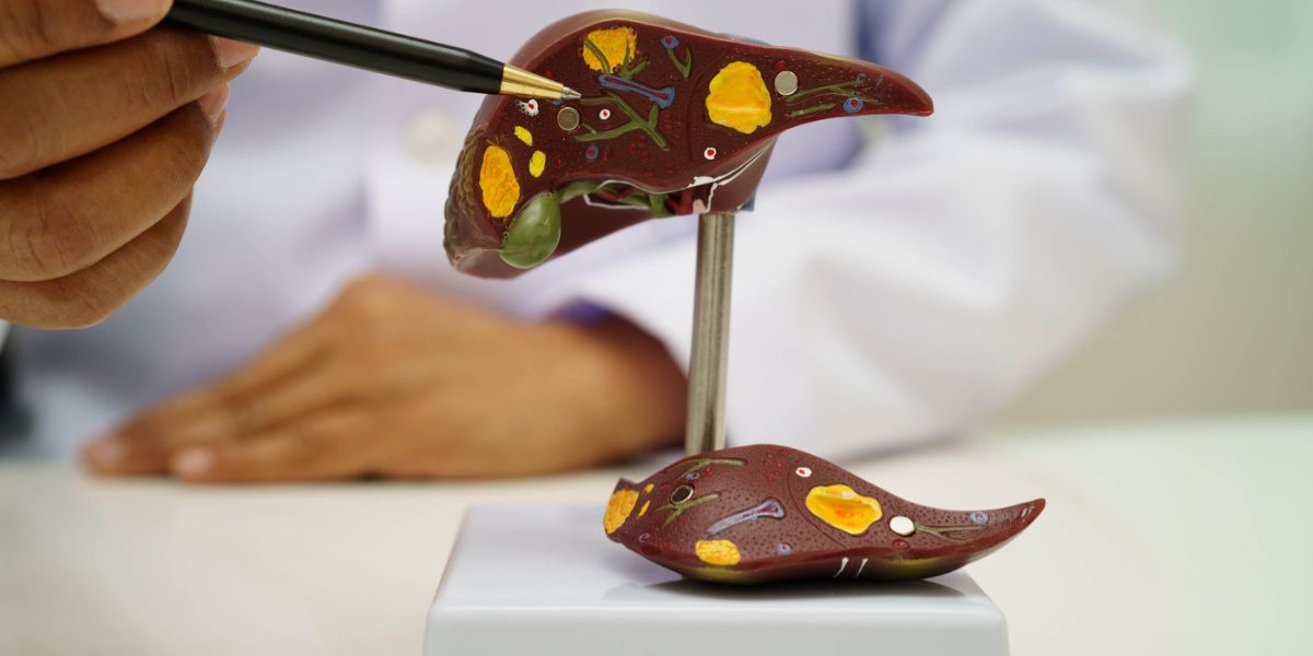 Boala ficatului gras: Atentie la acest “simptom”, avertizează medicii!