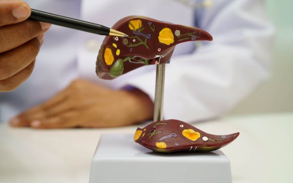 Boala ficatului gras: Atentie la acest “simptom”, avertizează medicii!