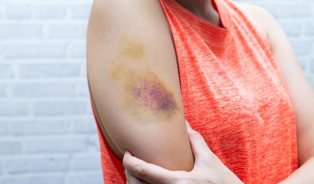 Vânătăi misterioase: Ai semne? S-ar putea să te confrunți cu o problemă medicală!