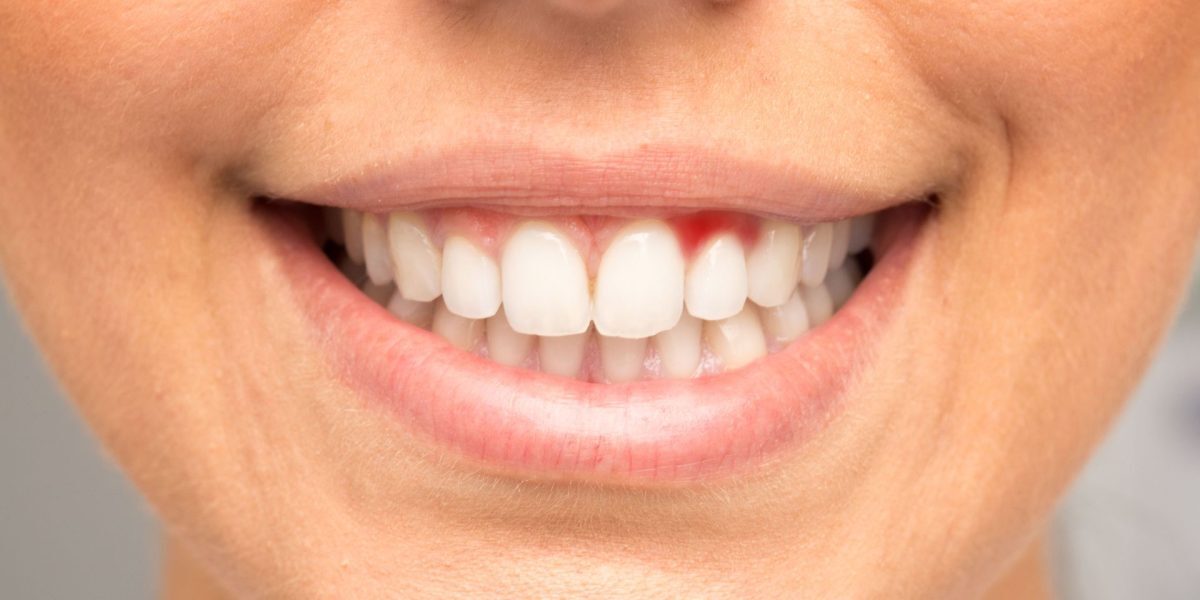 Gingiile sângerează: Semnal de alarmă pentru boli grave