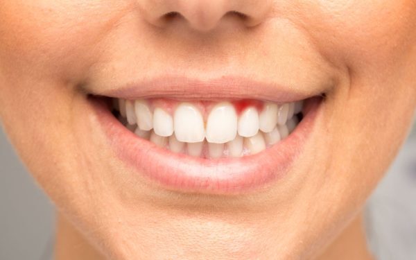 Gingiile sângerează: Semnal de alarmă pentru boli grave