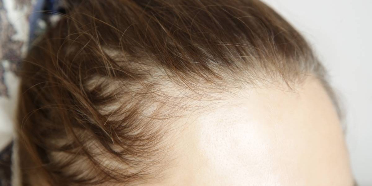 Injectii slăbit cauzează căderea părului? Legătura cu alopecia