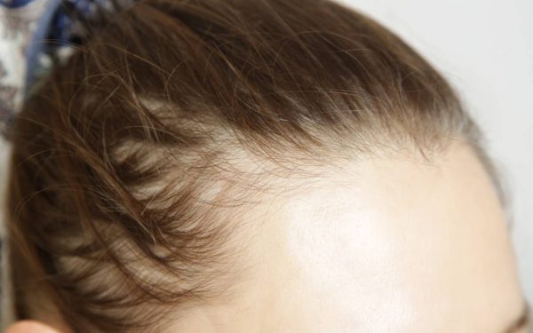 Injectii slăbit cauzează căderea părului? Legătura cu alopecia