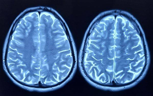Depresia blochează creierul: Nu mai produc neuroni