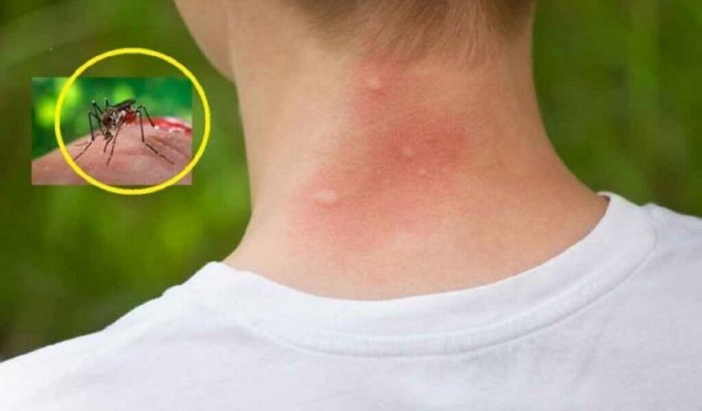 Țânțarii te aleg pe tine! Secretul bacteriilor dezvăluit