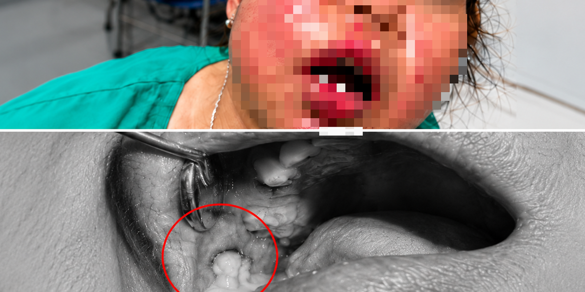 Diabet: Cum recunoști pericolul infecțiilor